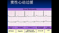 竇性心動過緩是什么意思