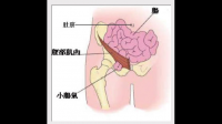 腹股溝直疝是什么意思？